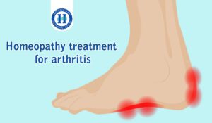 Homeopathy treatment for arthritis