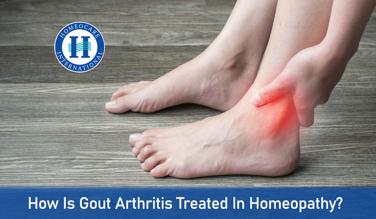 Read more about the article How is gout Arthritis treated in homeopathy?