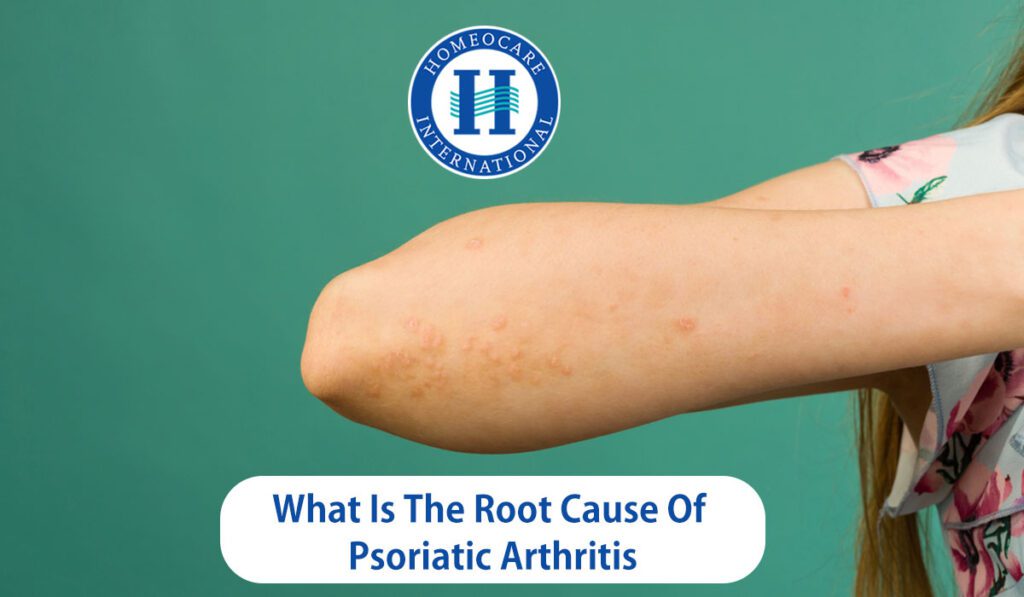 Psoriatic arthritis