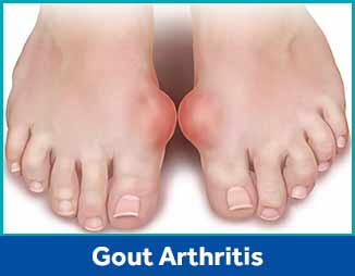 Gout Arthritis